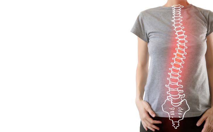 側弯症の女性の写真