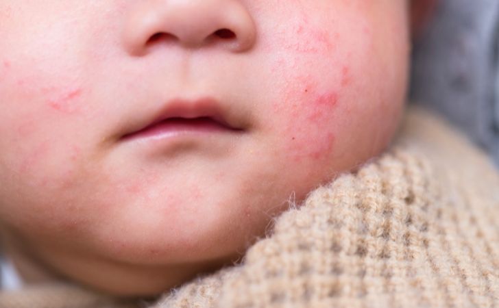 湿疹のある赤ちゃんの顔