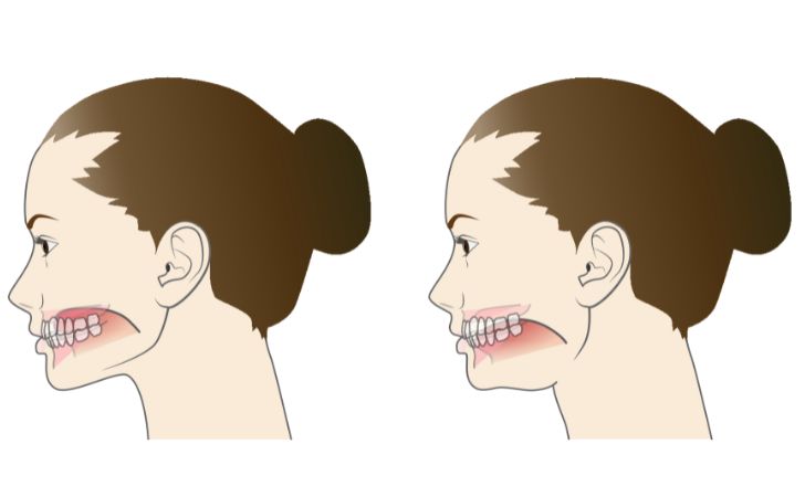 正しい舌の位置と悪い舌の位置のイラスト