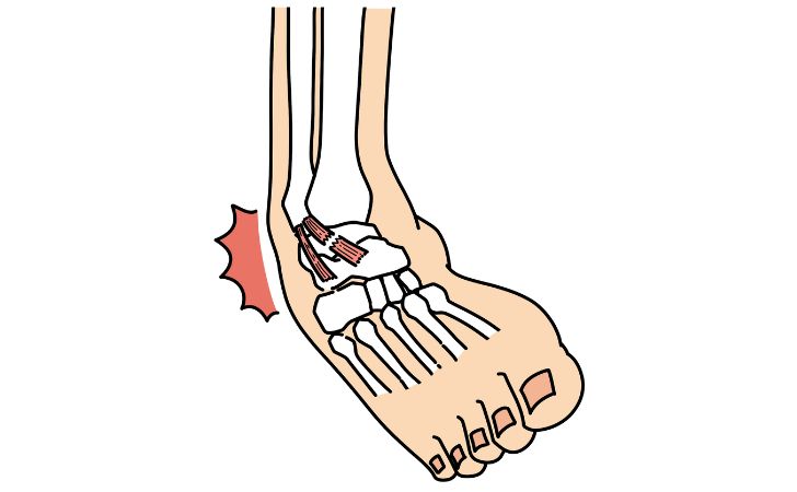 足関節捻挫のイラスト