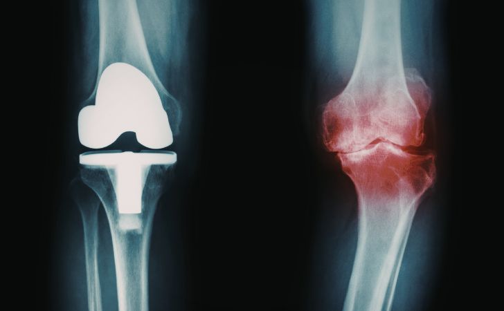 変形性膝関節症と人工関節置換術のレントゲン画像